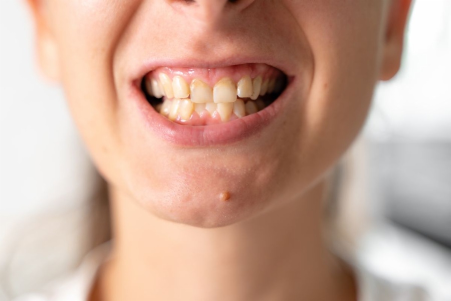 Alimentos que manchan los dientes poniéndolos amarillos