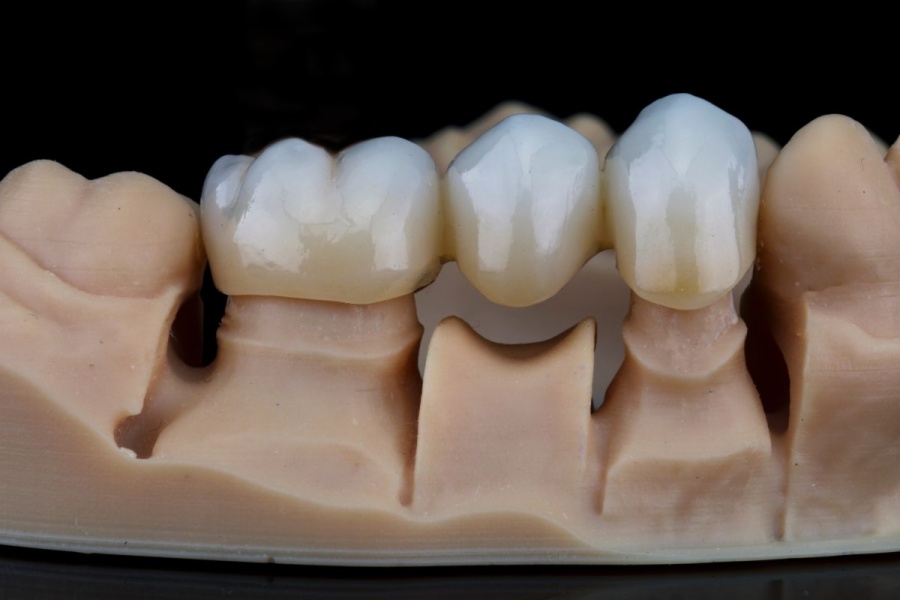 Carillas o fundas dentales, cuál elegir