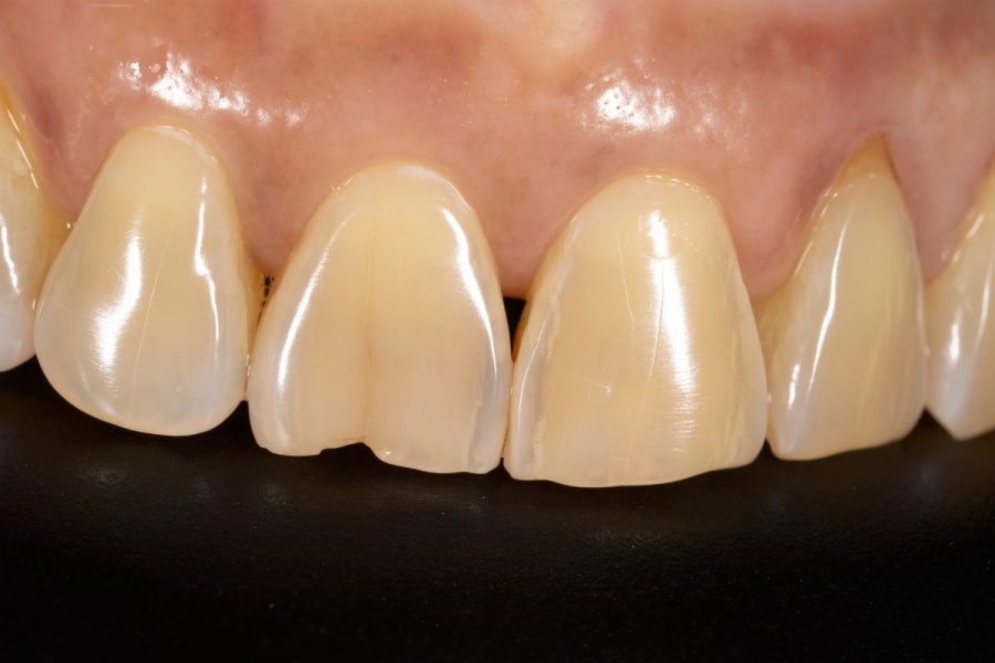 Dientes-astillados-soluciones