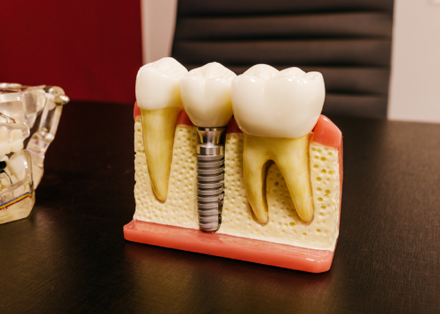 Rechazo de implante dental