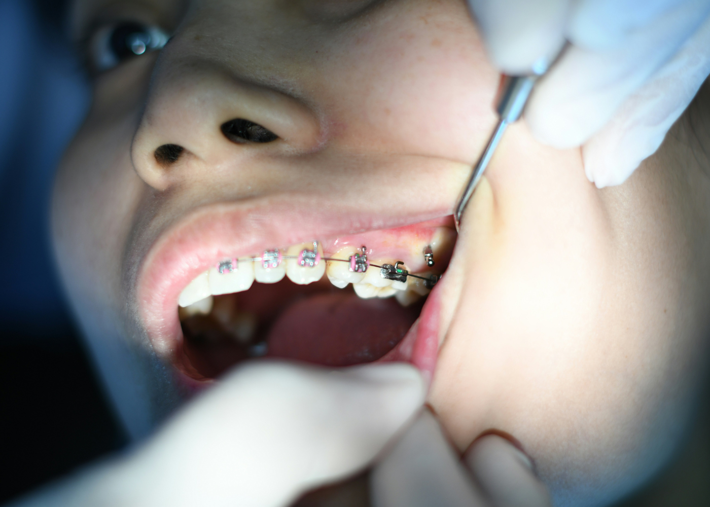Ortodoncia tradicional con brackets en la boca de un paciente durante visita al dentista